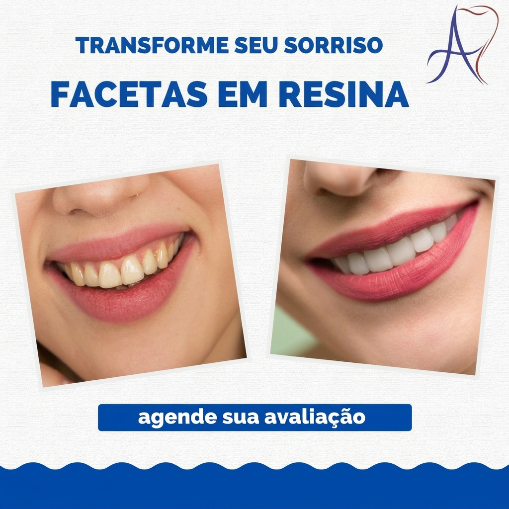 Antes e depois de facetas em resina